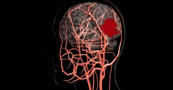 Felç sonrası bunama riski artıyor
