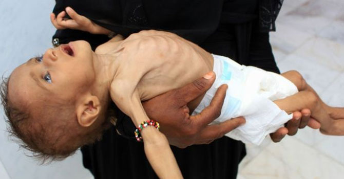 Yemen krizi: '85 bin çocuk açlıktan öldü'