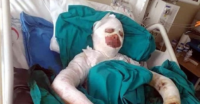 Bitlenen saçlarını benzinle yıkamak isterken kendini yaktı