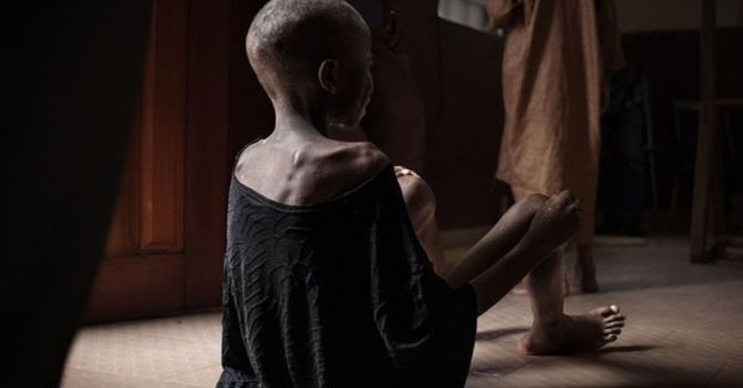 BM: Dünya genelinde 821 milyondan fazla insan aç