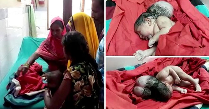 Hindistan'da üç başlı bebek doğdu