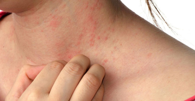 Doç. Demir: Uyuz artıyor, hastaların en az 8 gün cep telefonlarını kullanmaması gerekiyor