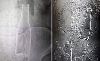 Karın ağrısı için hastaneye gitti vücudunda şişe çıktı