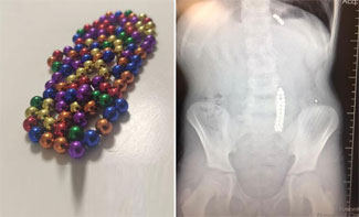 Bu oyuncaklara dikkat: Bağırsak yırtılmasına sebep olabilir