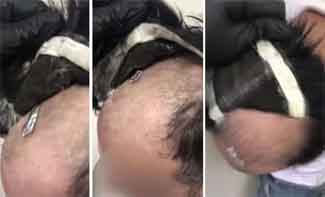 Başındaki peruğun altından uyuşturucu çıktı