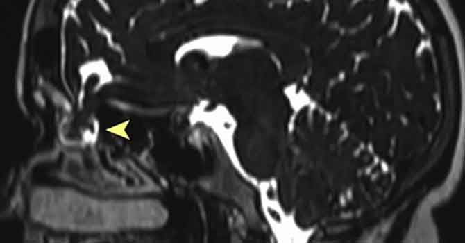 Koronavirüs testi sırasında kafatası duvarı delindi