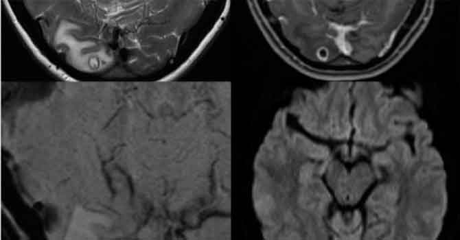 Doktorlar baş ağrısından şikayet eden kadının beyninde tenya larvası buldu