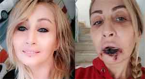 Estetik yaptırdığı dudağı çürüyerek düştü