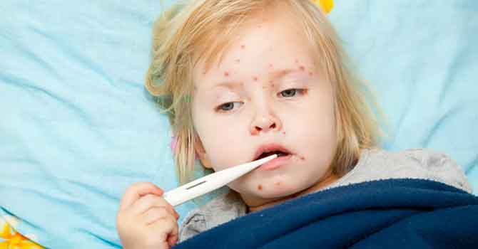 DSÖ: Kovid-19 kısıtlamaları kızamık vakalarını arttırdı