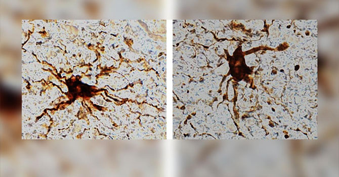 İnsan beyninde ölümden sonra harekete geçen "zombi genler" bulundu