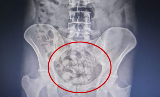 Midesinde 25 kapsül uyuşturucu ile yakalandı