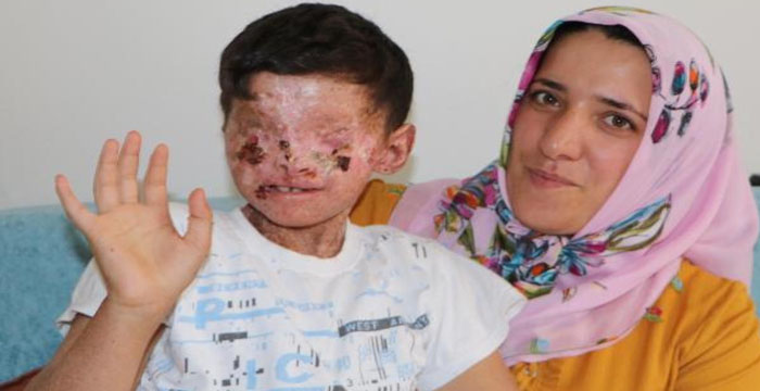 Gözleri kapanan cilt kanseri Salih'ten sevindirici haber