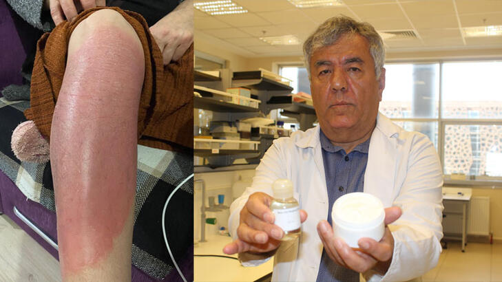 Egzama tedavisinde umut veren gelişme