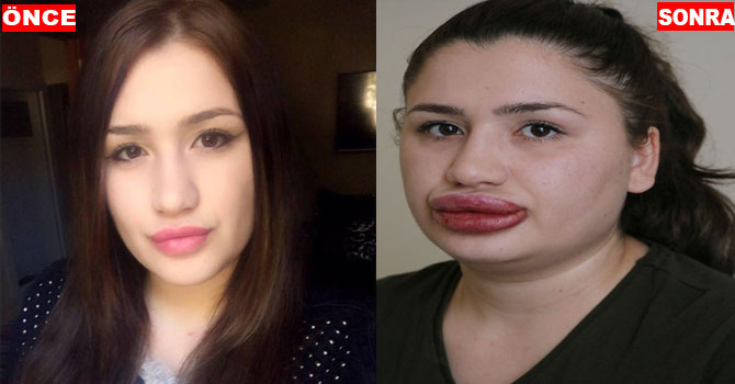 Hemşire Merve Keleş'in dudaklarına yapılan dolgu malzemesi aranıyor