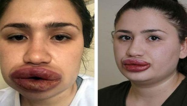 Silikon mağduru hemşireyle ilgili yeni gelişme