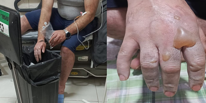 Hakkari’de Lavabo Açıcı Patlaması: İki Kardeş Ağır Yaralandı