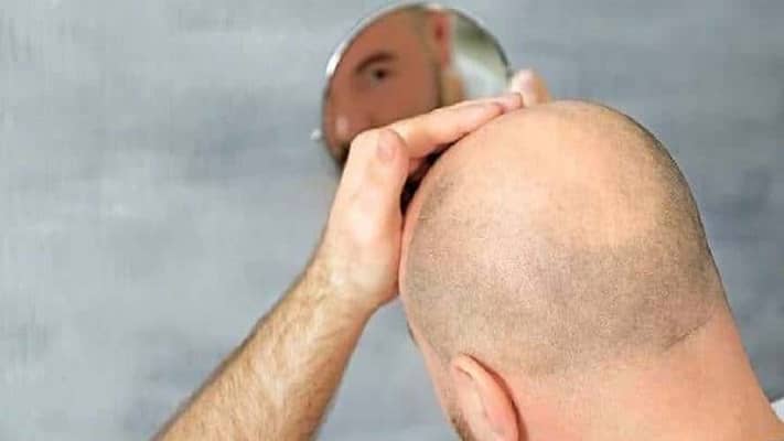 Türkiye’de Saç Ekim Maliyetini Belirleyen Faktörler