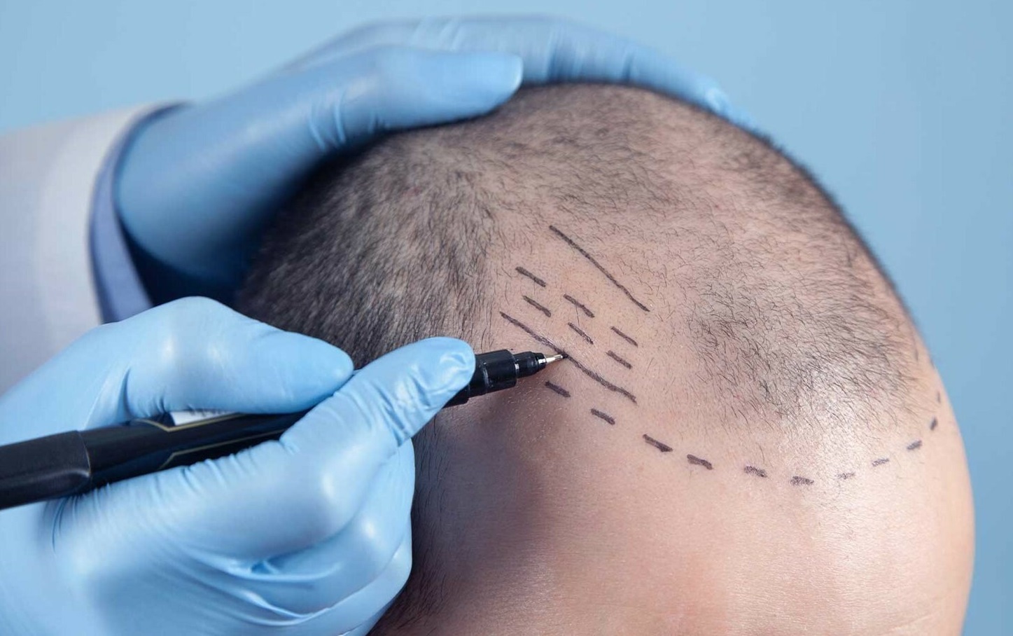 Türkiye’de Saç Ekim Maliyetini Belirleyen Faktörler